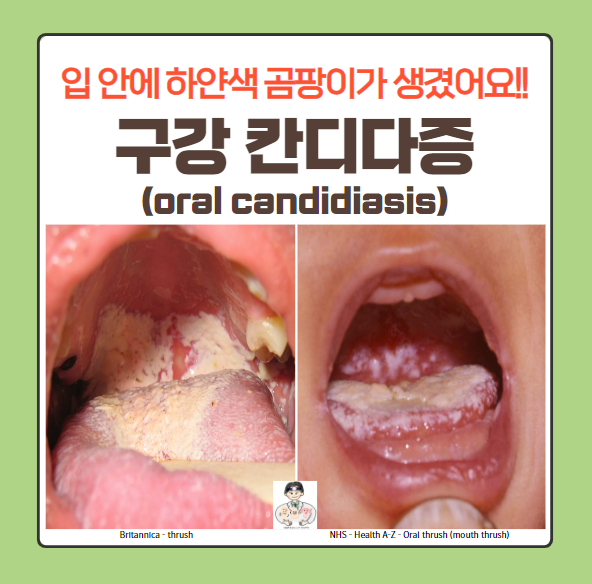  구강 칸디다증(oral candidiasis), 아구창(oral thrush)