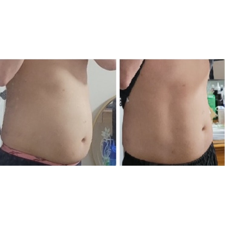  지방추출주사 한달차 -4kg 감량!! + 식단관리 꿀팁