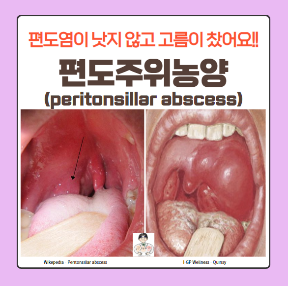  편도주위농양(peritonsillar abscess) - 편도염이 낫지 않고 고름이 찼어요!!