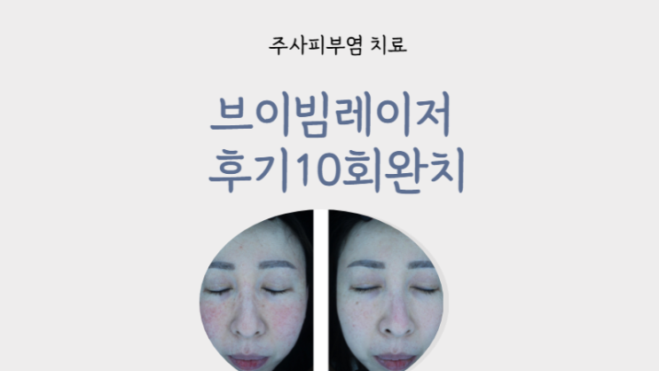  주사피부염 치료 브이빔 레이저 후기 10회 완치