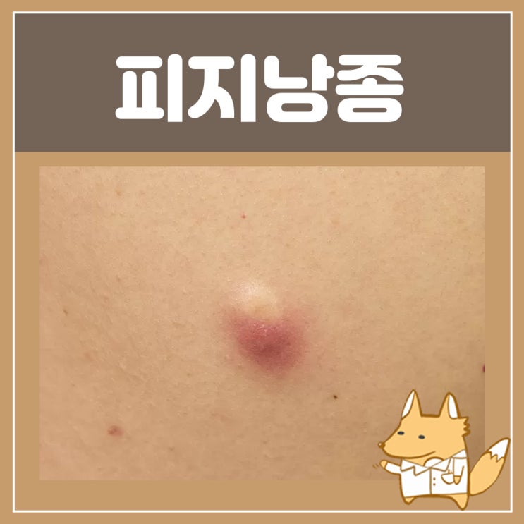  피지낭종제거 표피낭종 턱밑 귀뒤 멍울 목뒤에 혹 : 두피 겨드랑이 피지낭종 원인 귓볼 몽우리