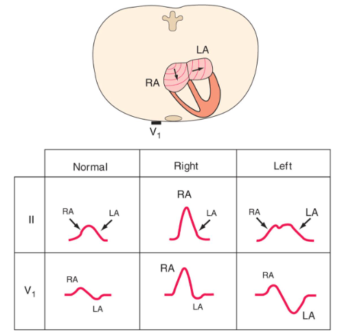 EKG, ECG, 심전도 기본개념(P, QRS, T, 심장 탈분극, SA node, NSR, Lead), QT prolong ...