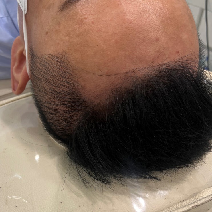  건대입구 smp 건대두피문신 아직도 고민하세요? 건대반영구 두피문신 잘하는곳 추천해드립니다.