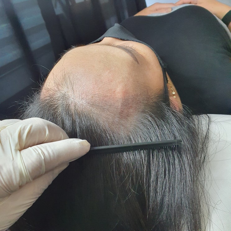  헤어라인두피문신 왜 받는 걸까?