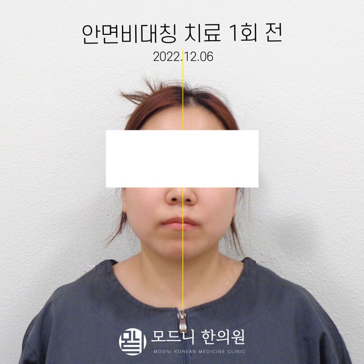  [서울/강남구] 모드니한의원 | 안면비대칭 교정으로 얼굴 비대칭제대로 잡아주는 곳 !(feat.추나요법,내돈내산)