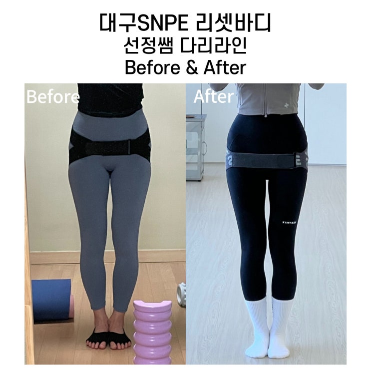  [대구SNPE] 1급 인증강사 선정쌤의 변화 - 다리교정
