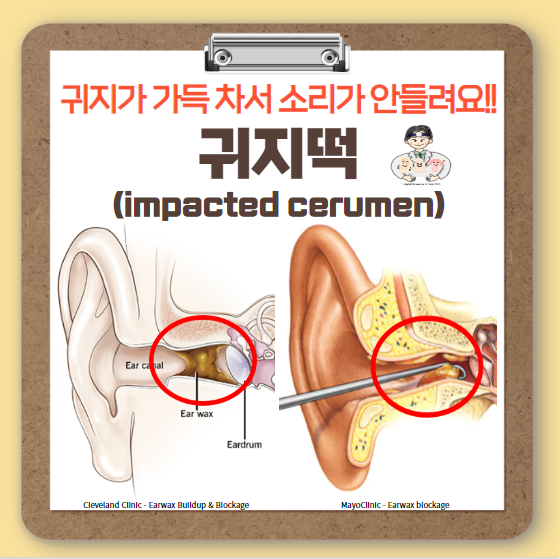  귀지떡(impacted cerumen, 이구전색) - 귀지가 가득 차서 소리가 안들려요!