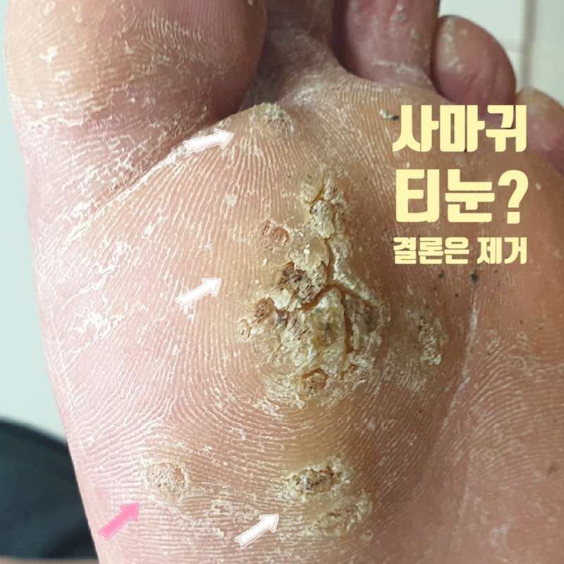 티눈 사마귀 제거 수원시청역 위치 야간진료 피부과