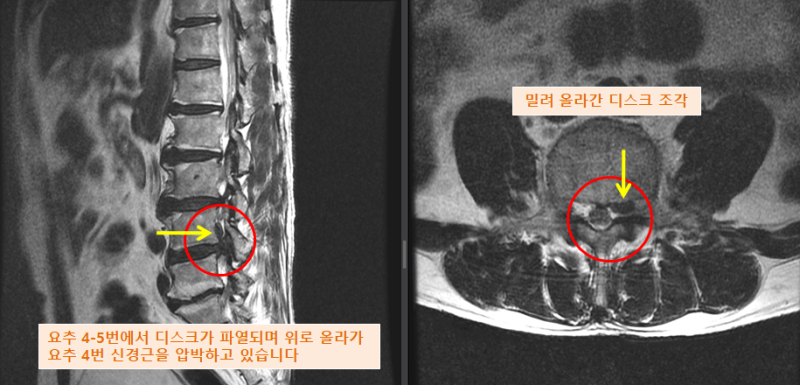 좌측 엉치부터 다리까지 너무 아파요 (요추 4-5번간 좌측 추간판 수핵탈출증, upward migration) : 네이버 블로그