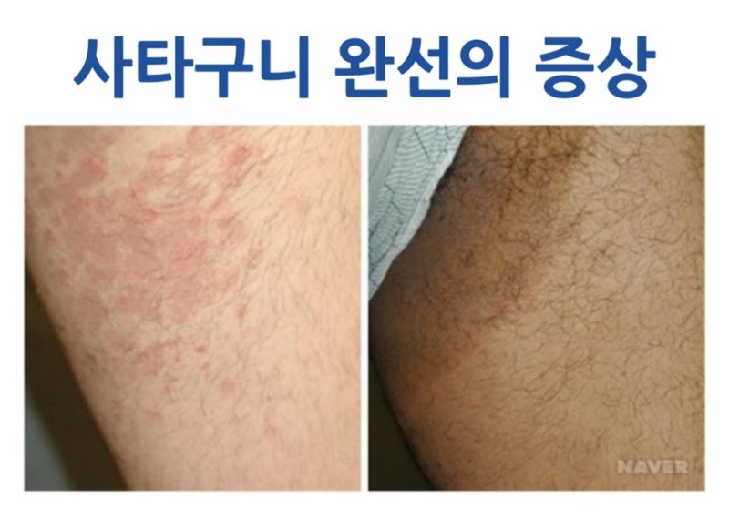 습할 때 찾아오는 피부질환[무좀, 피부감염, 사타구니완선, 기러기 등]부산피부질환