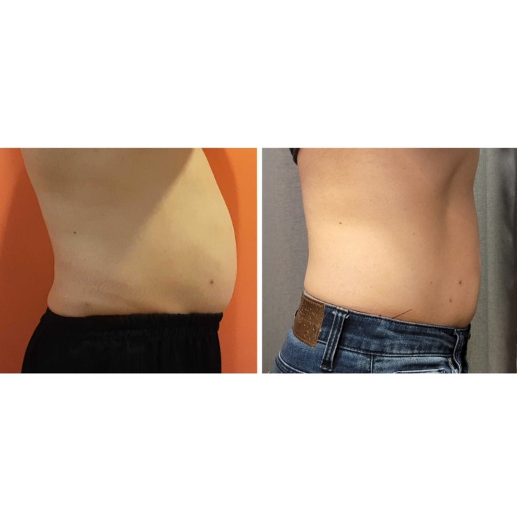  뱃살주사 맞고 한달만에 -4kg 감량!!