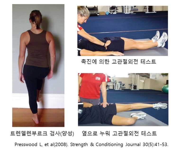 중간볼기근(중둔근, Gluteus Medius) 근력평가, 대퇴근막장근 우세(협력근우세, Synergistic dominance)와 근력훈련
