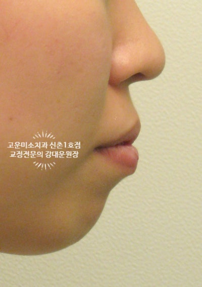  무턱 2급부정교합 돌출입 거미스마일 잇몸관리 필요한 치주교정 증례  신촌치아교정치과 고운미소 신촌1호점 증례