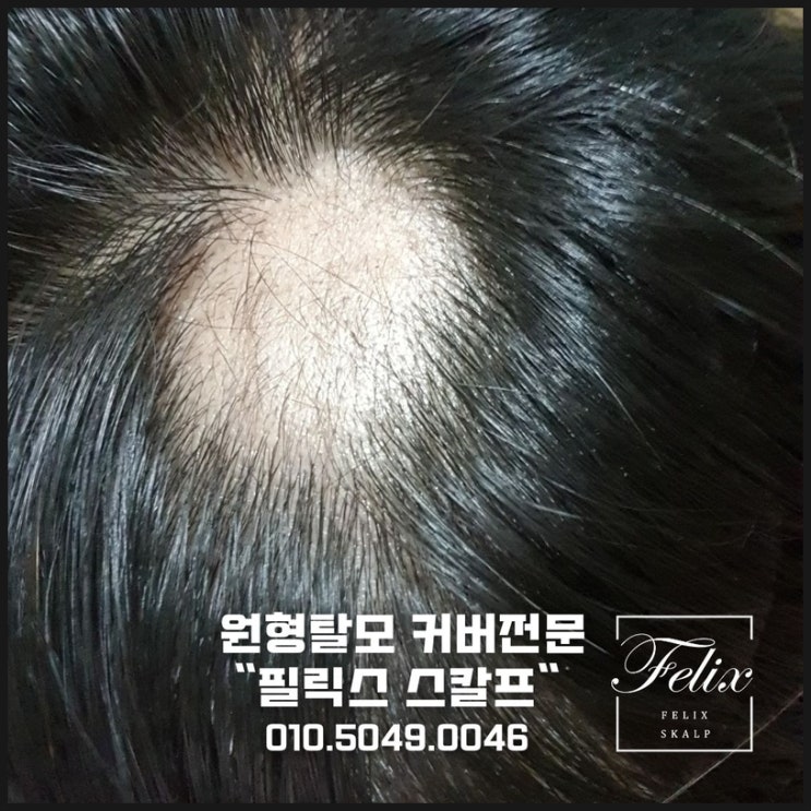  [필릭스 스칼프]김포정수리탈모커버 김포가르마탈모커버 SMP로 젊어져 보세요~!(김포 제물포 인천 부천 강남 양주 군산)