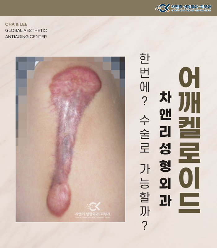  어깨켈로이드 한번에 수술로 가능할까?