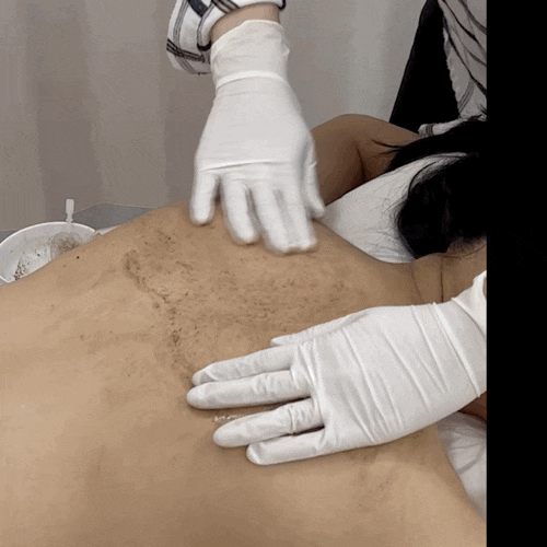  홍대 여드름흉터관리 아르엘에스테틱 등 알라딘필링 후기!
