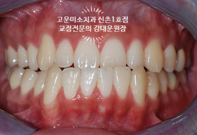  3급부정교합 반대교합 주걱턱  비수술교정치료 신촌치아교정치과 고운미소치과 신촌1호점 치료 증례 (2부)