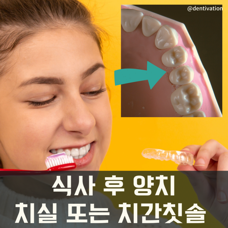  투명교정 인비절라인 관심있다면, 주의사항 먼저 알아보기!