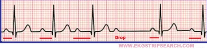 EKG 종류, 흔한 심전도 유형 24가지, 간단 소개 : 네이버 블로그