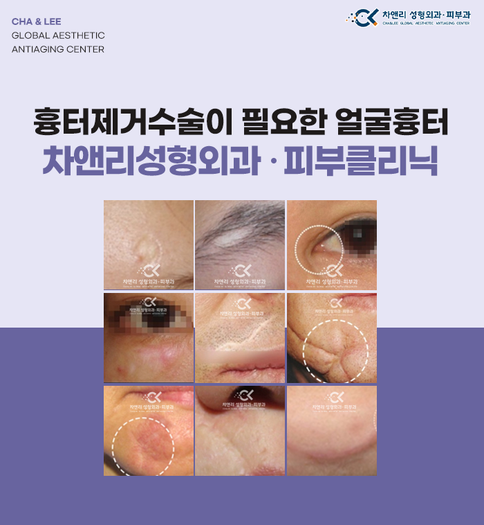  얼굴흉터제거 상담전 보세요