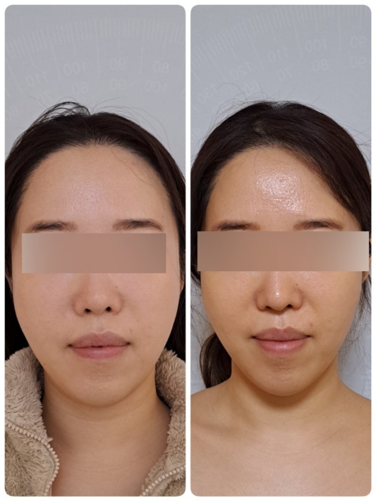  사당역 에스테틱 추천 ll 전스에스테틱에서 윤곽관리 후기