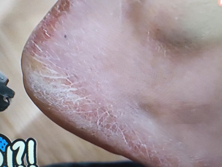  "추운 겨울 발뒤꿈치 갈라질 때 무조건 족욕이 답이다"