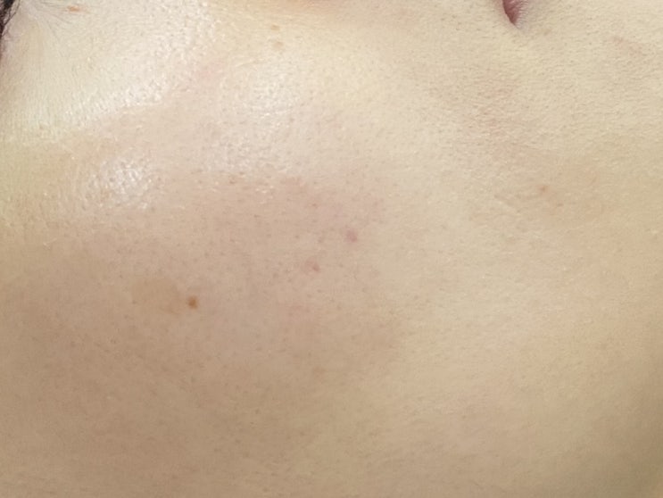  인계동 피부과)피코토닝으로 기미 잡티 타파하기!