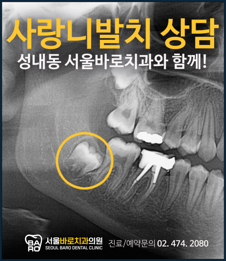  사랑니 발치는 무조건 하는 것인지, 성내동치과에서 알려드립니다.