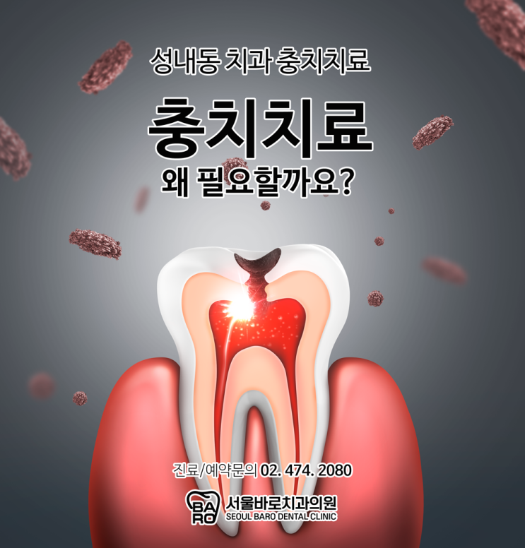  성내동치과에서 충치치료가 왜 필요한지 알려드립니다.