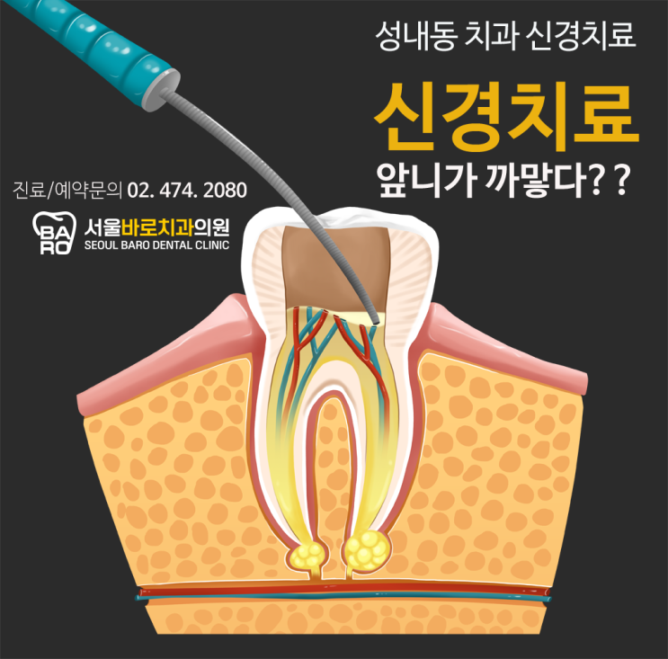  앞니가 까맣게 변하고 있다면, 성내동 치과에서 신경치료에 대해 알려드립니다.