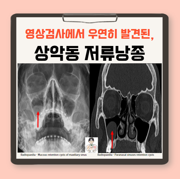  상악동 저류낭종(maxillary sinus retention cyst)