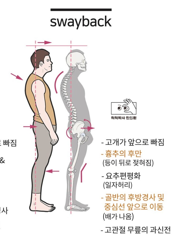  노량진 한의원 굽은 등 스웨이백 Sway back 체형 교정 치료법