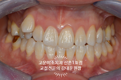  덧니와 정중선안맞는 비발치 치료증례 교정치과 신촌치과 고운미소신촌1호점 치료증례