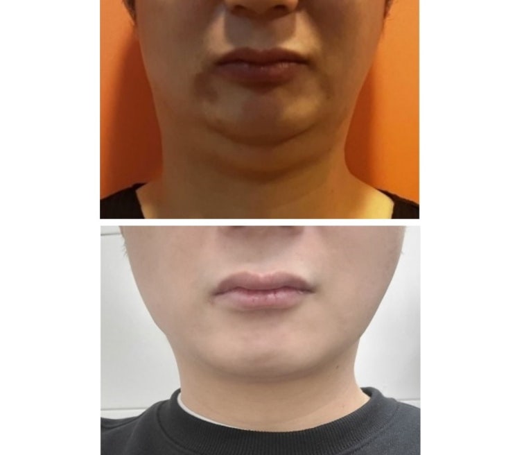 얼굴 람스 후기 이중턱 완벽하게 제거!!