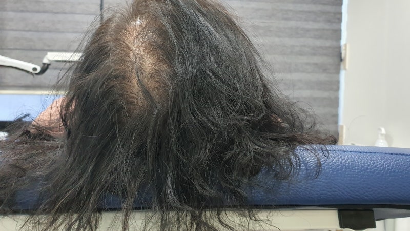 대구 탈모 치료 병원 전문의약품 처방 없이 성공하는 시크릿 공식