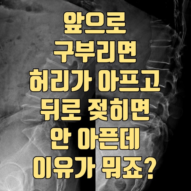  앞으로 구부리면 허리가 아프고 뒤로 젖히면 안 아픈데 이유가 뭐죠?