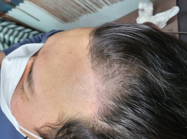  전주 헤어라인 두피문신, 여러분은 얼굴만 성형하세요?