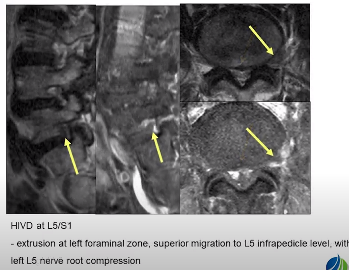 [통증정리] spine MRI reading part 5(에이스병원 유튜브) : 네이버 블로그