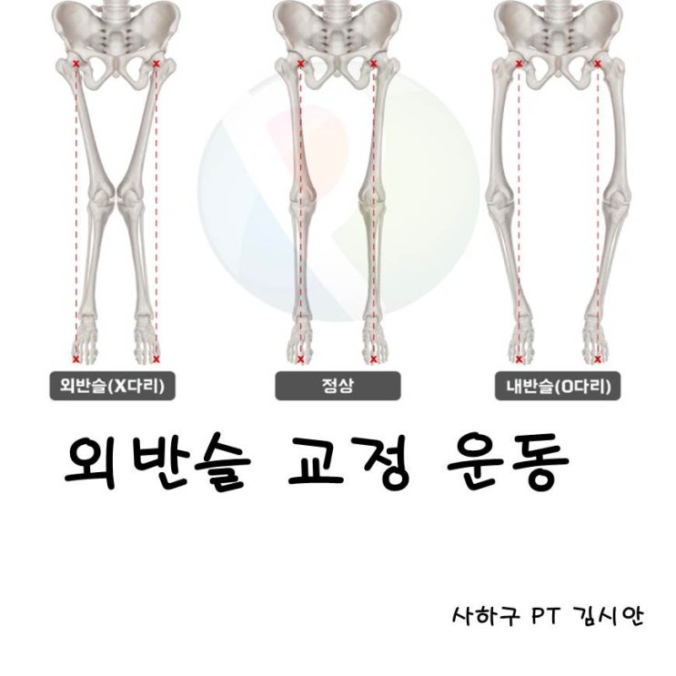 외반슬, 안짱다리 교정 운동 이렇게 해보세요 사하구 PT