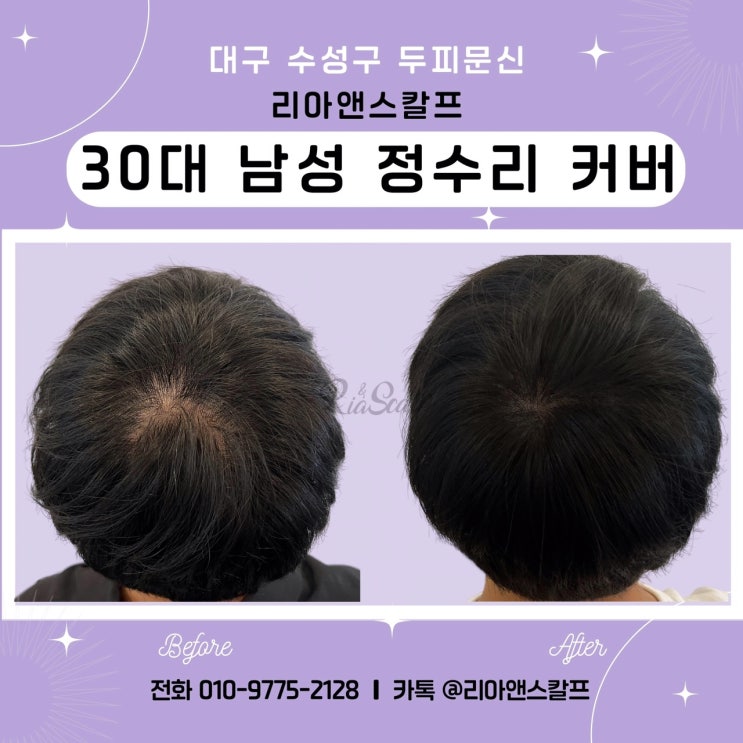  대구 두피문신 잘하는 곳에서 알려주는 SMP두피문신 누가 하면 자연스러운가?