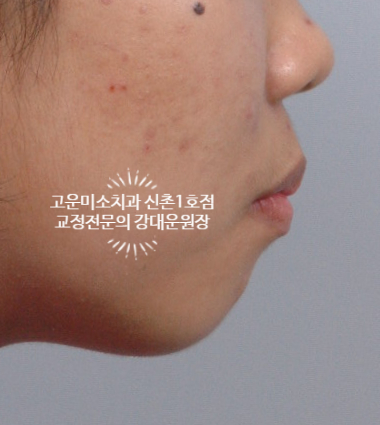  돌출입 무턱교정 재교정 비수술 교정치료 신촌치과 고운미소치과 신촌1호점 치료증례
