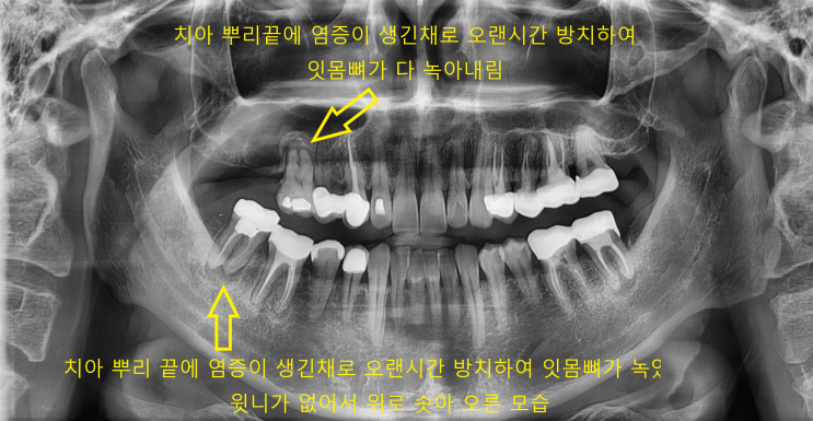  마천동 방이동 오륜동치과, 골이식을 동반한 고난이도 임플란트 식립했습니다.