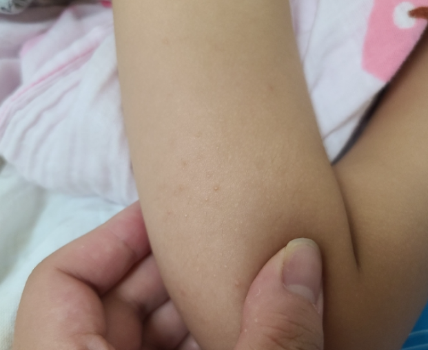 유아 모공각화증 애 잡을뻔 했어요