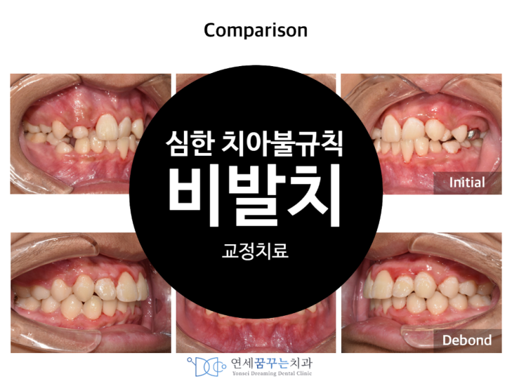 심한 치아 불규칙(틀어짐), 발치없이 교정치료하기(비발치 교정)