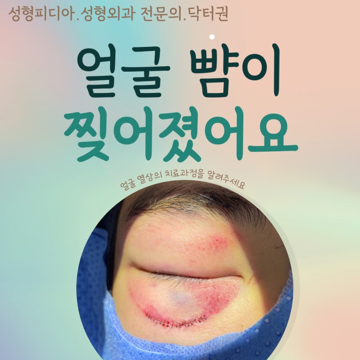  [안면열상] 뺨이 찢어졌어요 (feat. 일차봉합술)