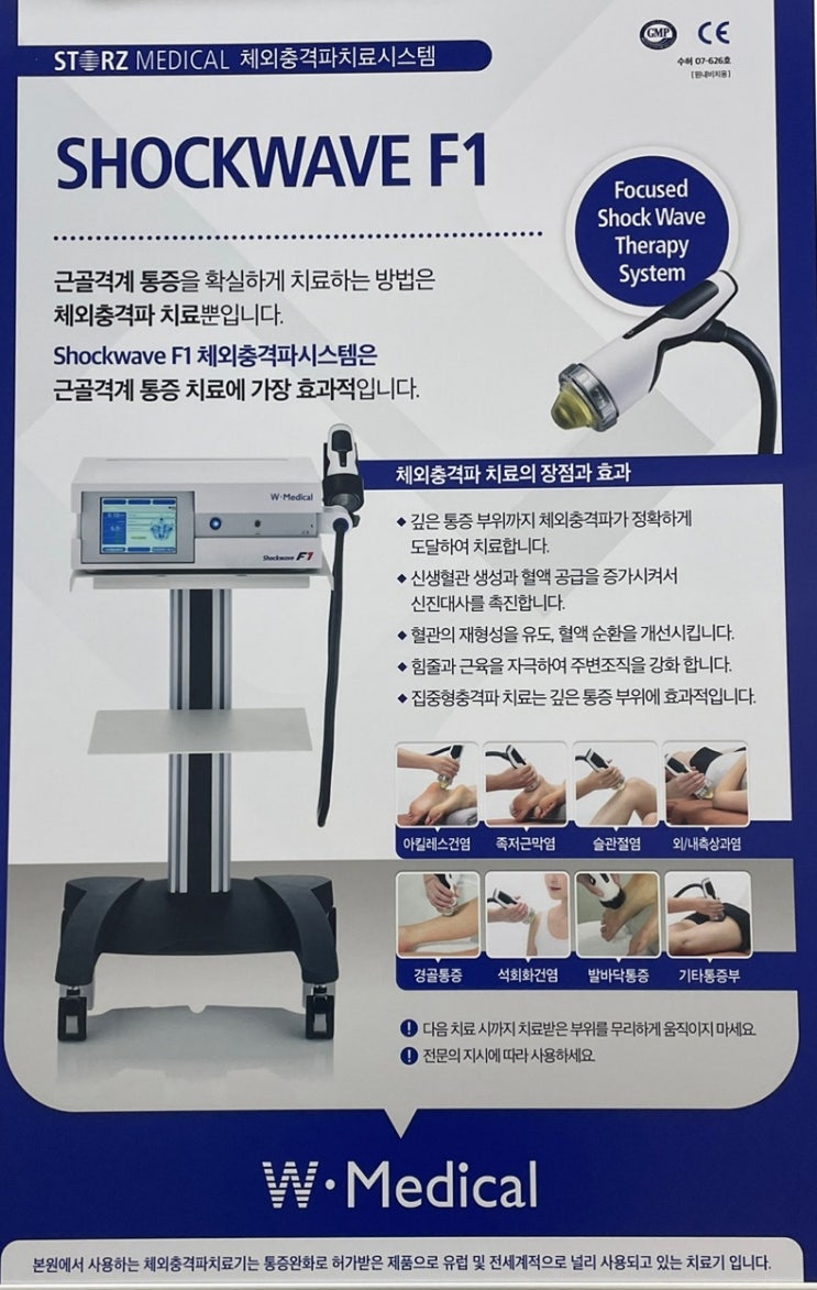  집중형 체외 충격파 치료란??