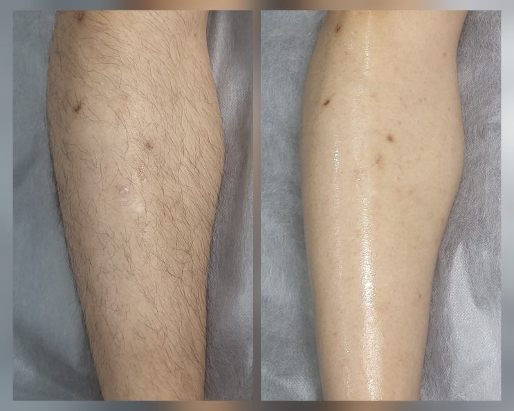  김포 팔다리왁싱 뽀블슈가링왁싱&뷰티 김포점 후기