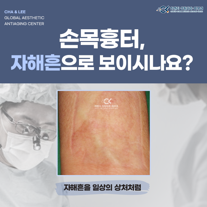  손목흉터, 자해흔으로 보이시나요?