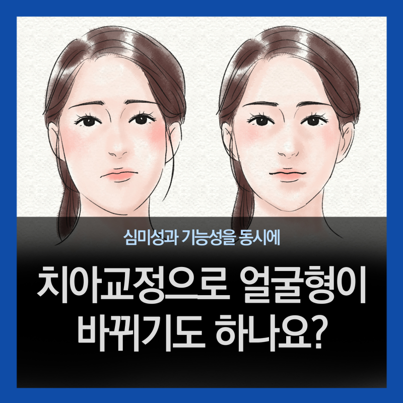 치아교정으로 얼굴형이 바뀌기도 하나요? : 네이버 블로그 치아교정으로 얼굴형이 바뀌기도 하나요? : 네이버 블로그