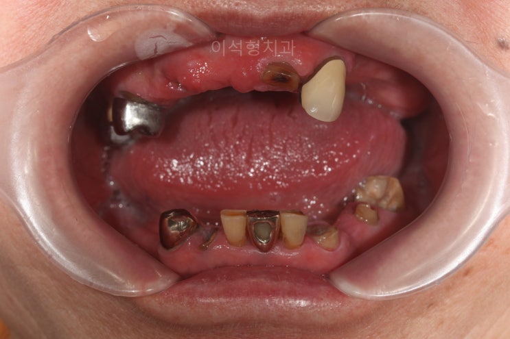 일원동 치과, 대청역 치과 고령 환자 , 임플란트 없이 틀니와 크라운 치료
